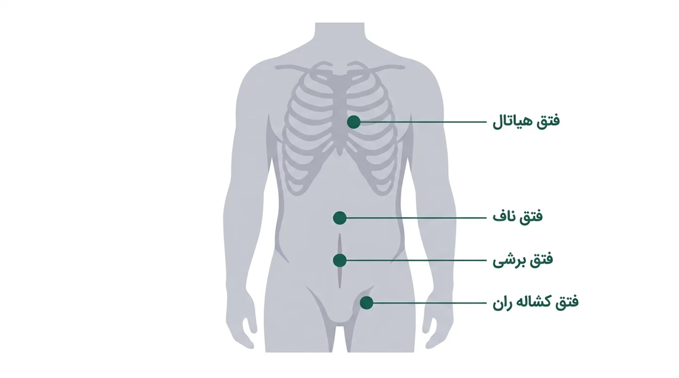 نمودار بدن که محل چهار نوع فتق را نشان می‌دهد: فتق هیاتال، فتق ناف، فتق برشی و فتق کشاله ران