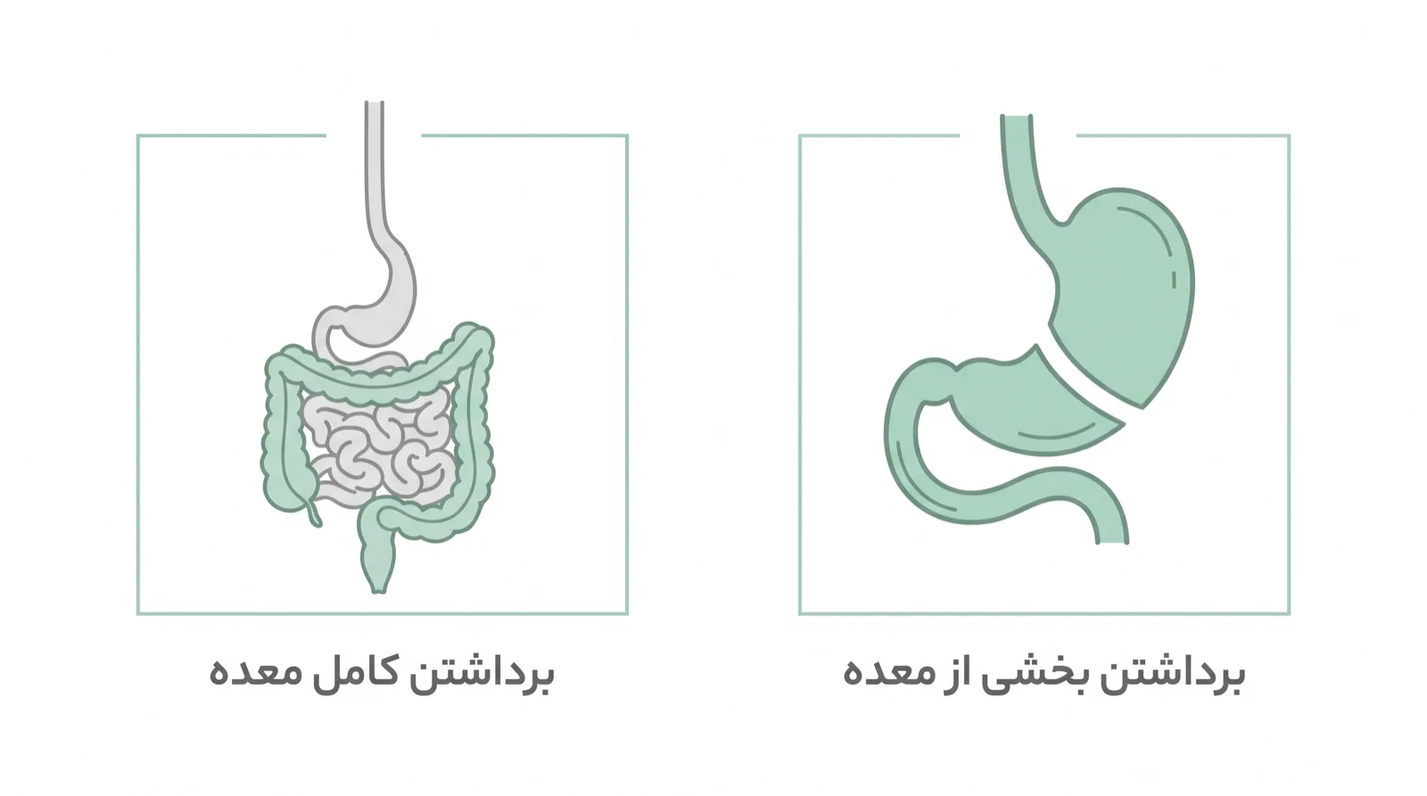 مقایسه برداشتن بخشی از معده با برداشتن کامل معده در جراحی سرطان